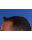After Hair Transplant&nbsp;2 Sessions (Areas)